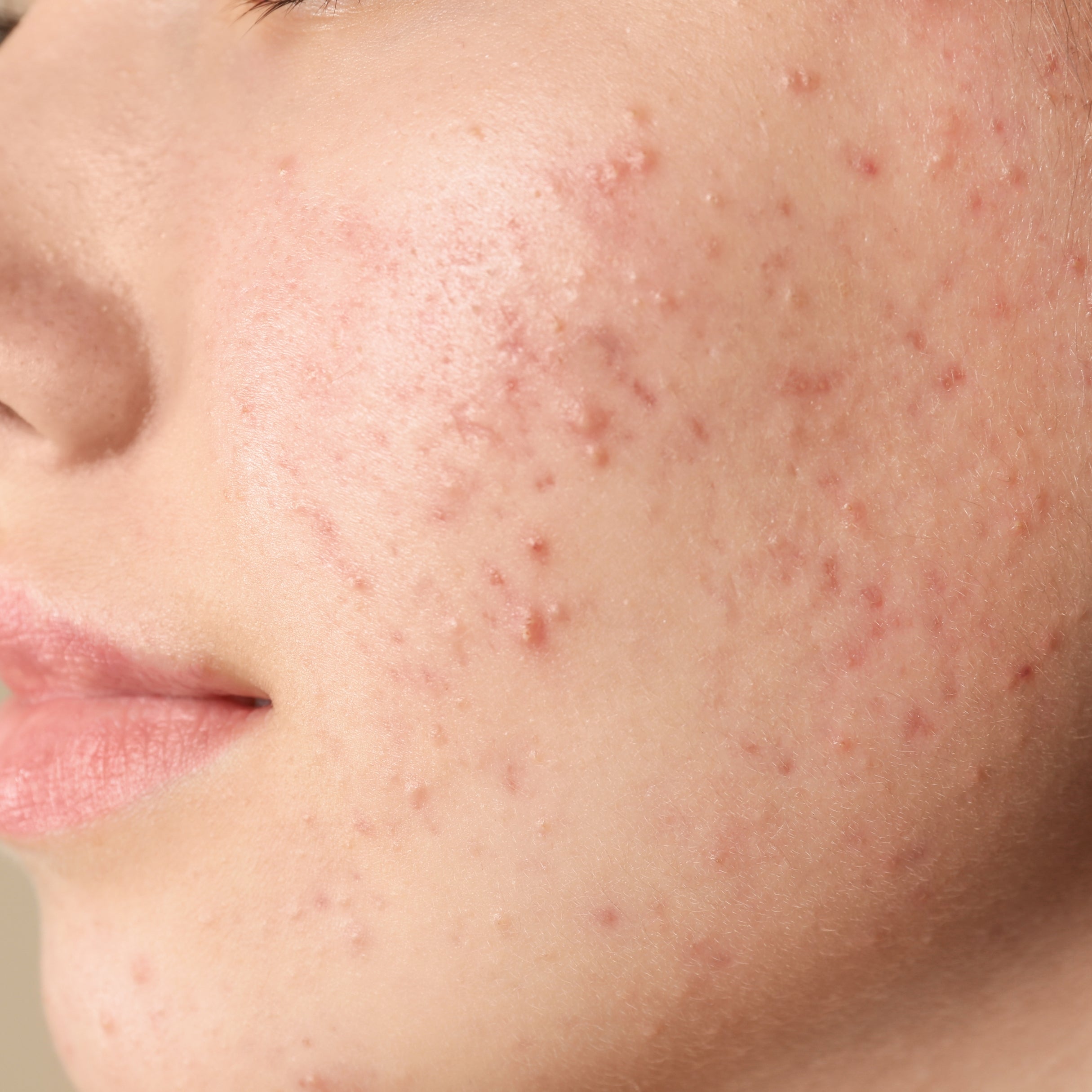 Acne