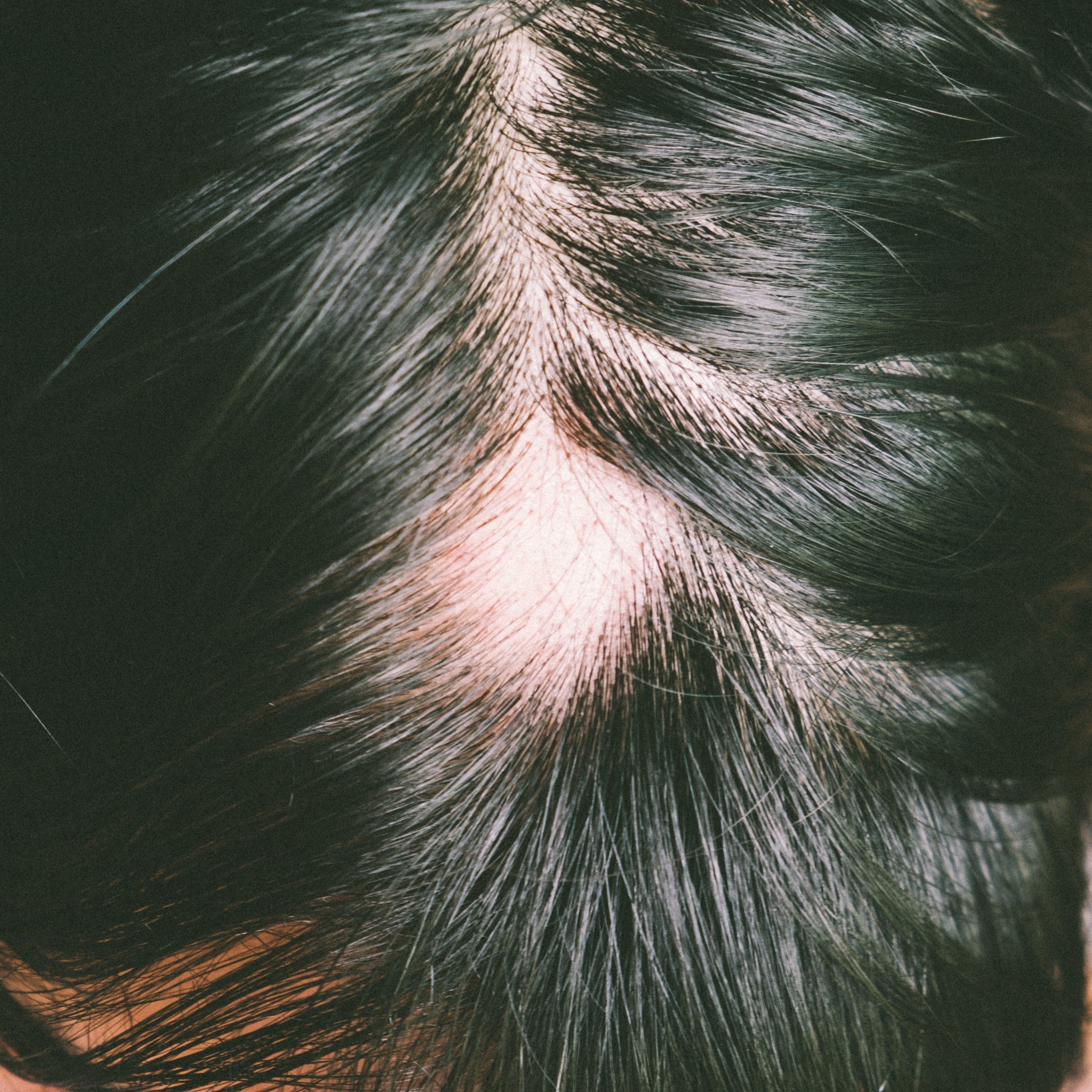 Hairfall