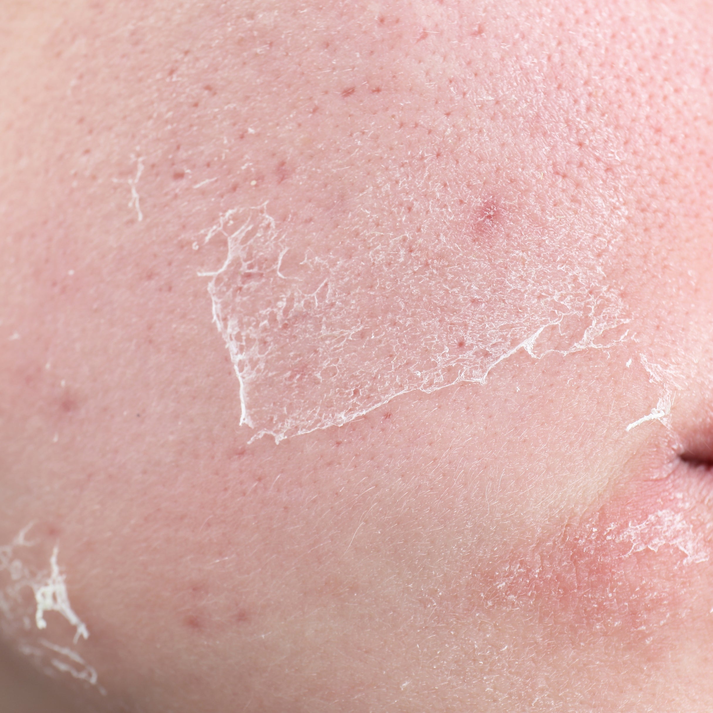 Dry Skin