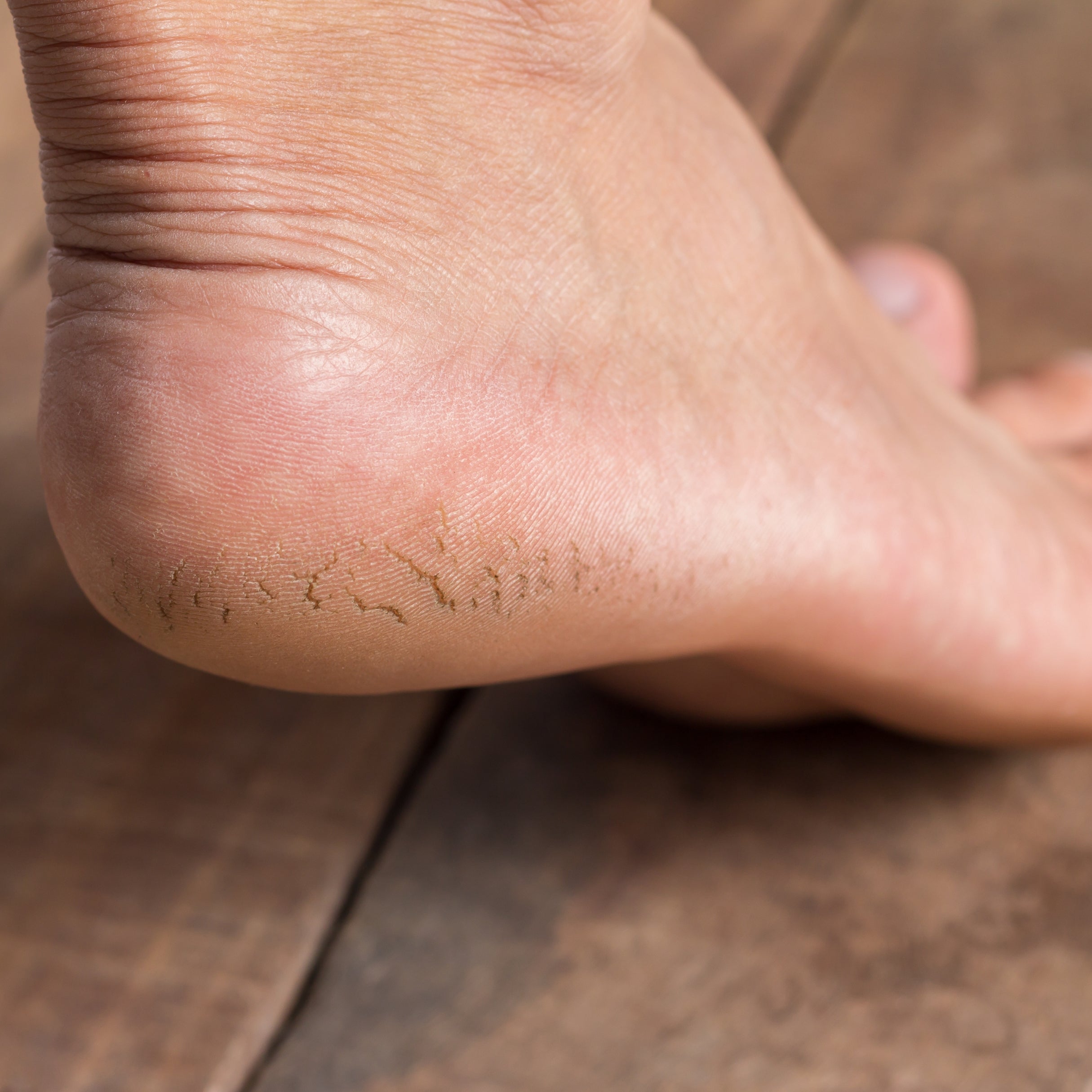Cracked Heel